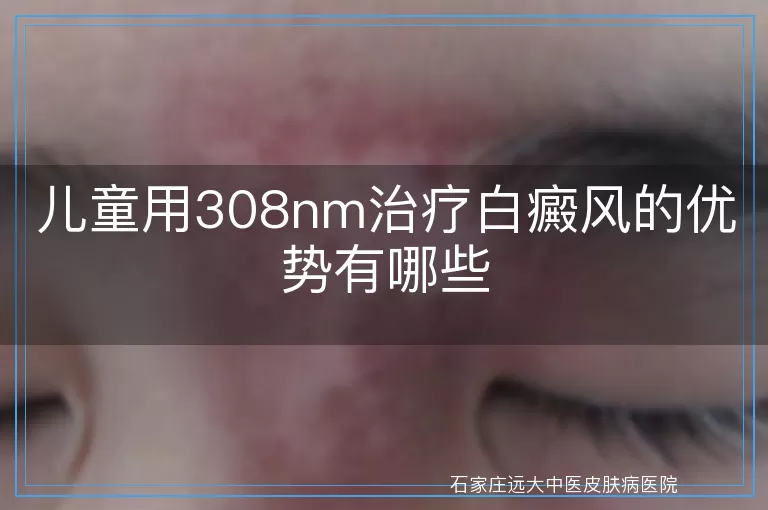儿童用308nm治疗白癜风的优势有哪些