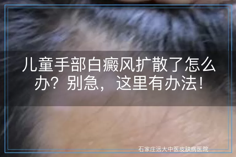 儿童手部白癜风扩散了怎么办？别急，这里有办法！