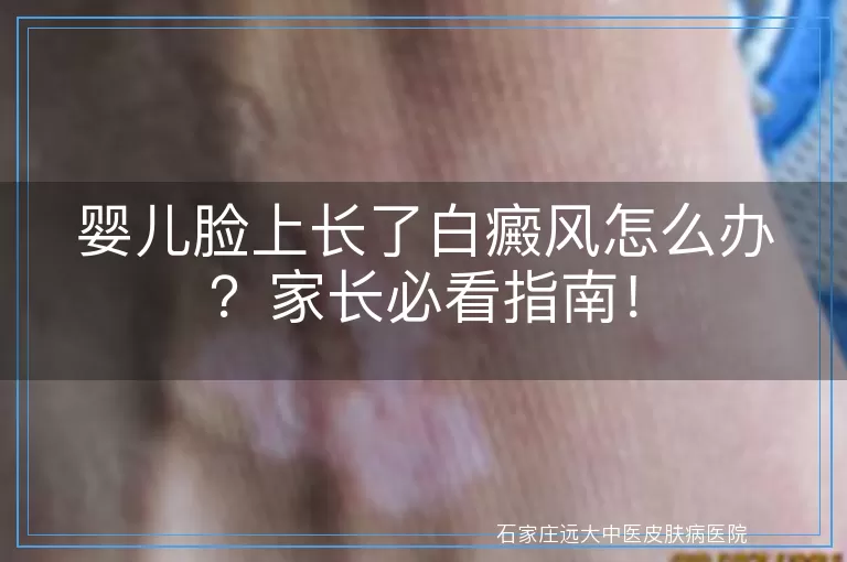 婴儿脸上长了白癜风怎么办？家长必看指南！