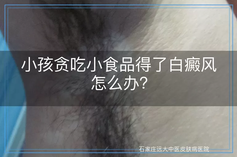 小孩贪吃小食品得了白癜风怎么办？