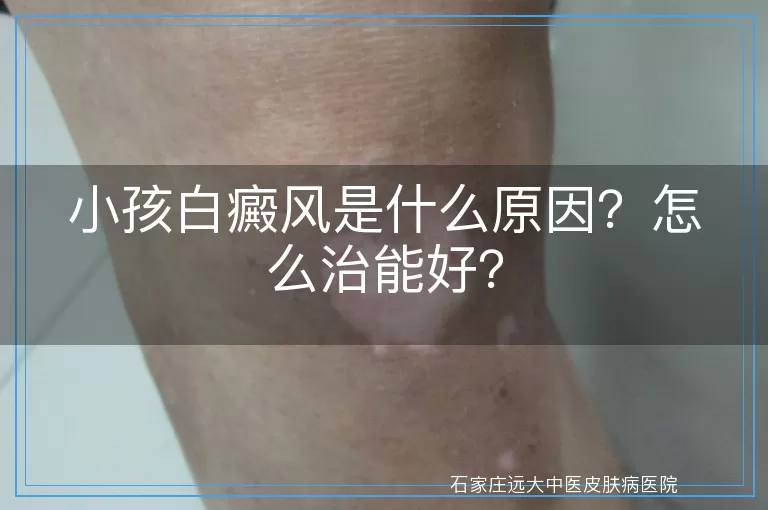 小孩白癜风是什么原因？怎么治能好？