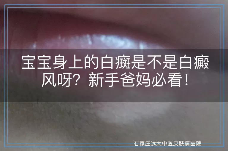 宝宝身上的白癍是不是白癜风呀？新手爸妈必看！