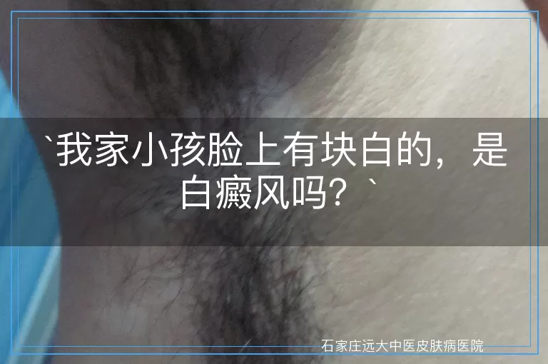我家小孩脸上有块白的，是白癜风吗？