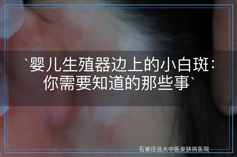 婴儿生殖器边上的小白斑：你需要知道的那些事