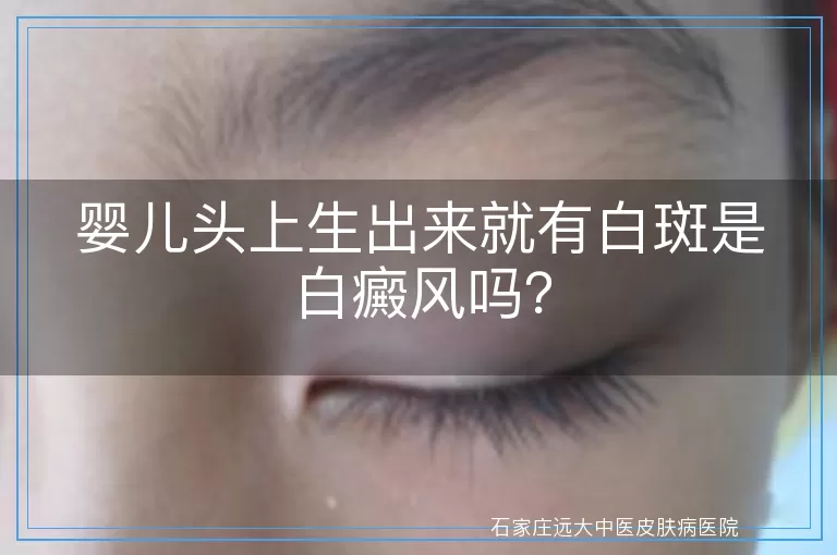 婴儿头上生出来就有白斑是白癜风吗？