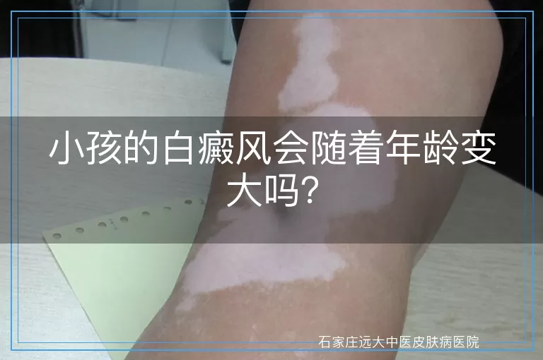 小孩的白癜风会随着年龄变大吗？