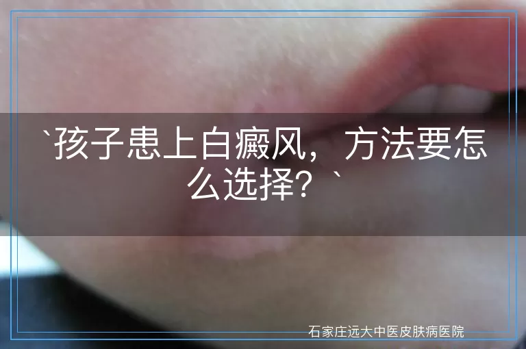 孩子患上白癜风，方法要怎么选择？