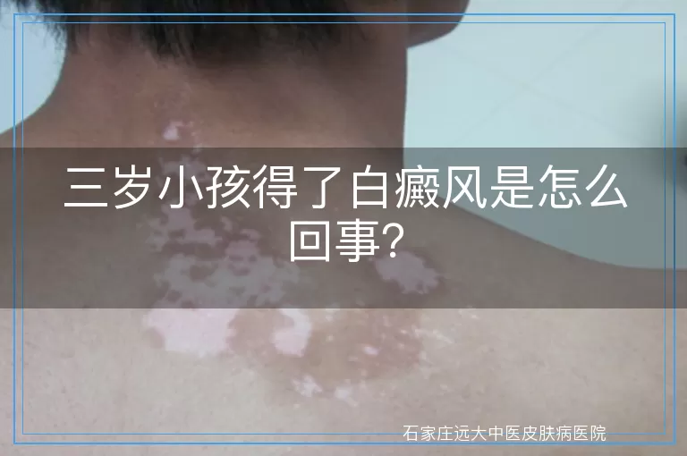 三岁小孩得了白癜风是怎么回事？