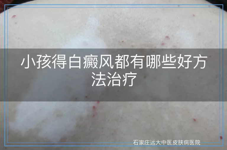 小孩得白癜风都有哪些好方法治疗