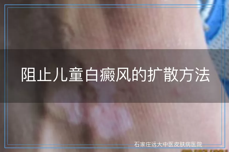 阻止儿童白癜风的扩散方法