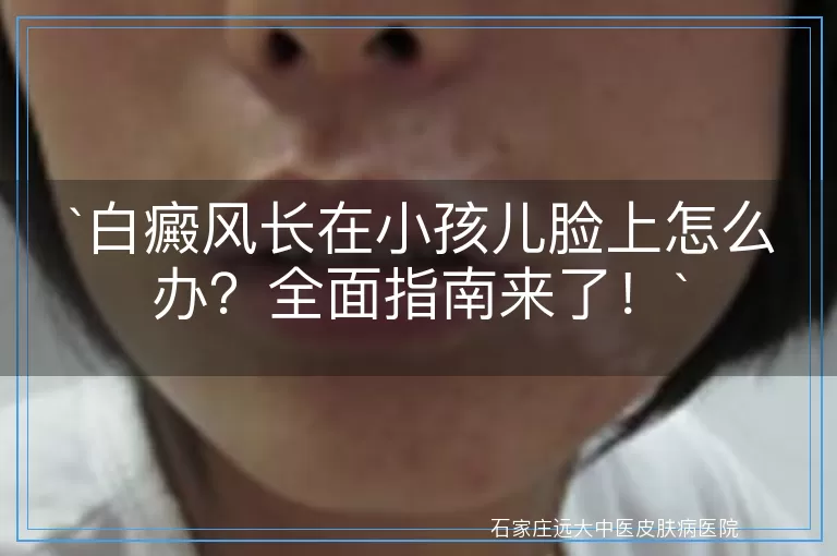 白癜风长在小孩儿脸上怎么办？全面指南来了！