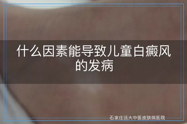 什么因素能导致儿童白癜风的发病