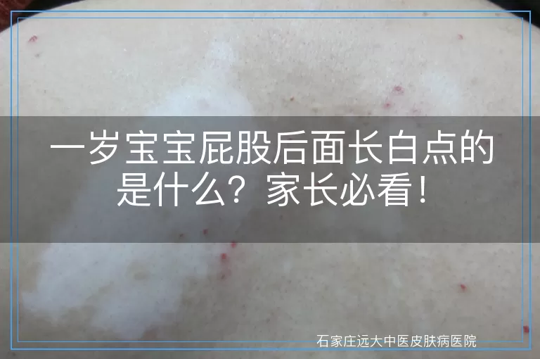 一岁宝宝屁股后面长白点的是什么？家长必看！