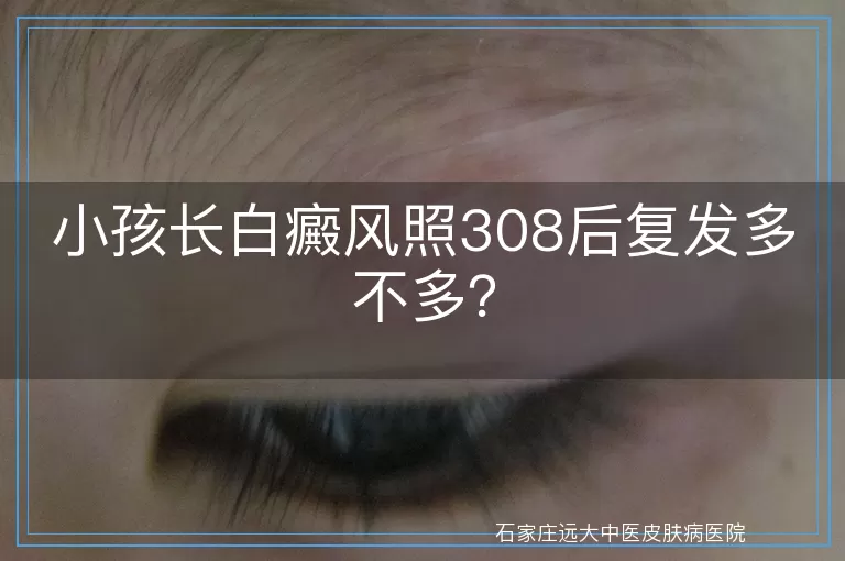 小孩长白癜风照308后复发多不多？