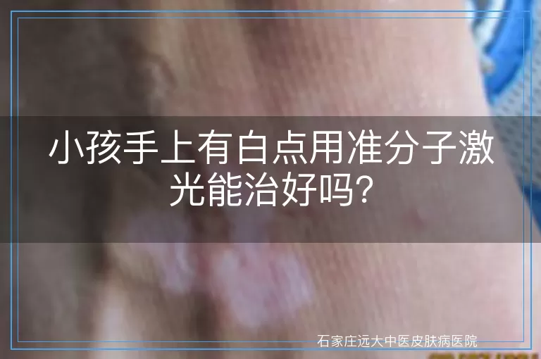 小孩手上有白点用准分子激光能治好吗？