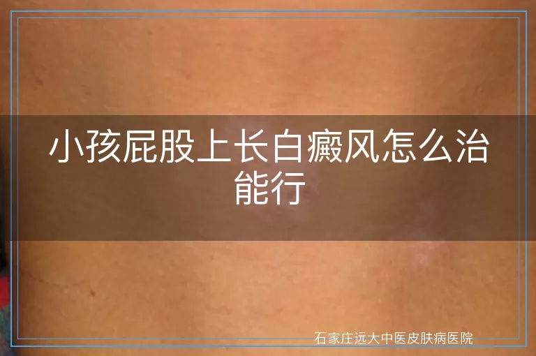 小孩屁股上长白癜风怎么治能行