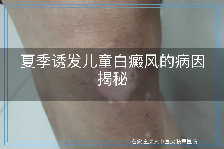 夏季诱发儿童白癜风的病因揭秘