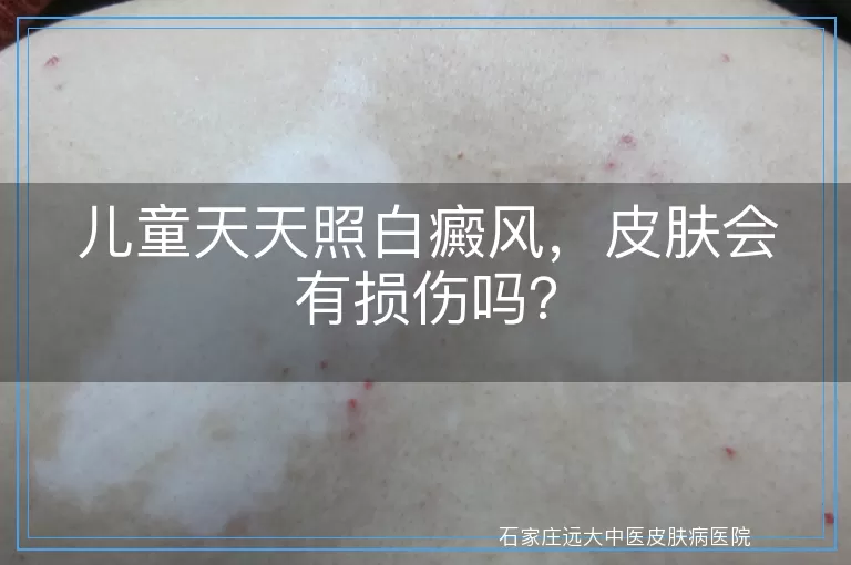 儿童天天照白癜风，皮肤会有损伤吗？