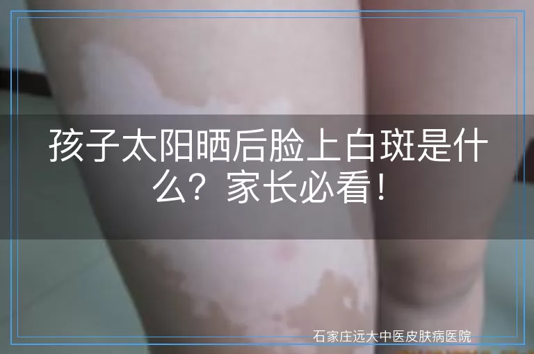 孩子太阳晒后脸上白斑是什么？家长必看！