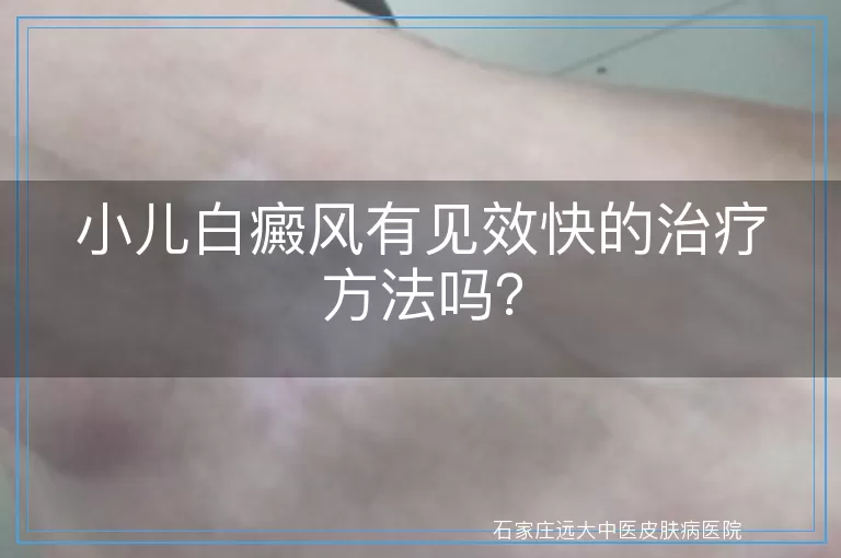 小儿白癜风有见效快的治疗方法吗？