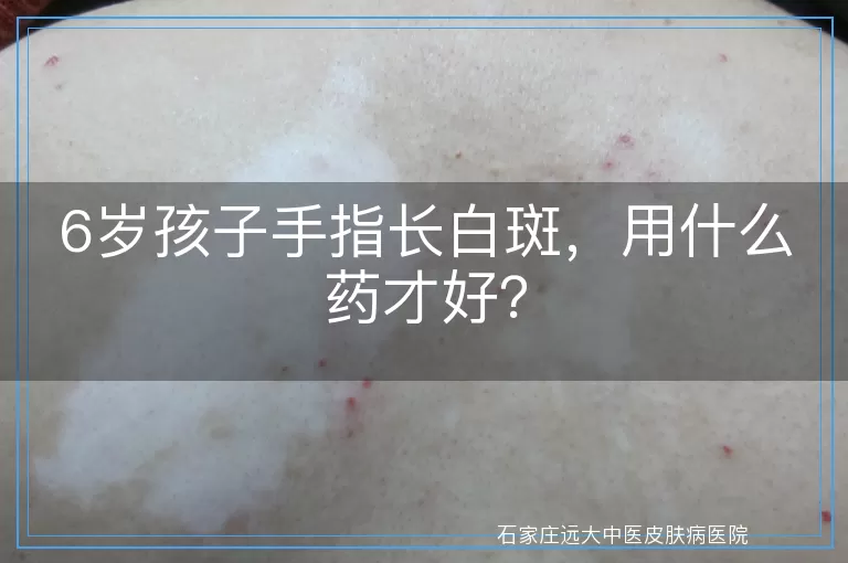 6岁孩子手指长白斑，用什么药才好？