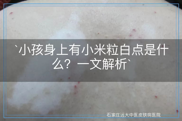 小孩身上有小米粒白点是什么？一文解析