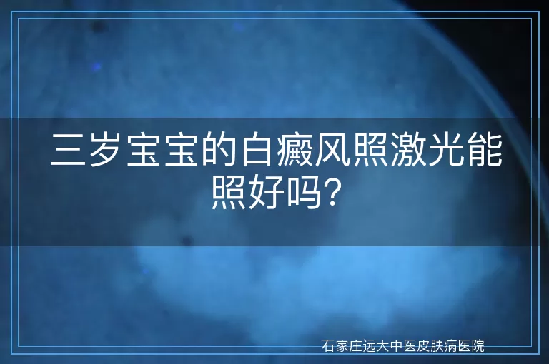 三岁宝宝的白癜风照激光能照好吗？