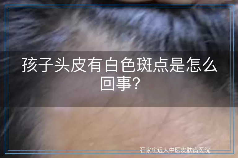 孩子头皮有白色斑点是怎么回事？