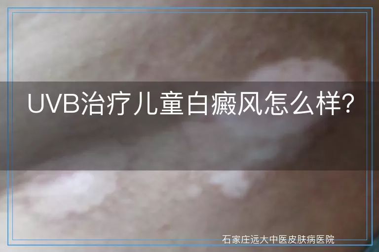 UVB治疗儿童白癜风怎么样？