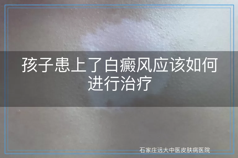 孩子患上了白癜风应该如何进行治疗
