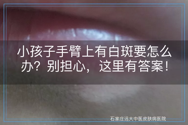 小孩子手臂上有白斑要怎么办？别担心，这里有答案！