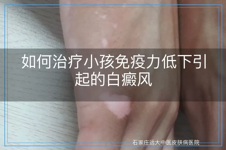 如何治疗小孩免疫力低下引起的白癜风