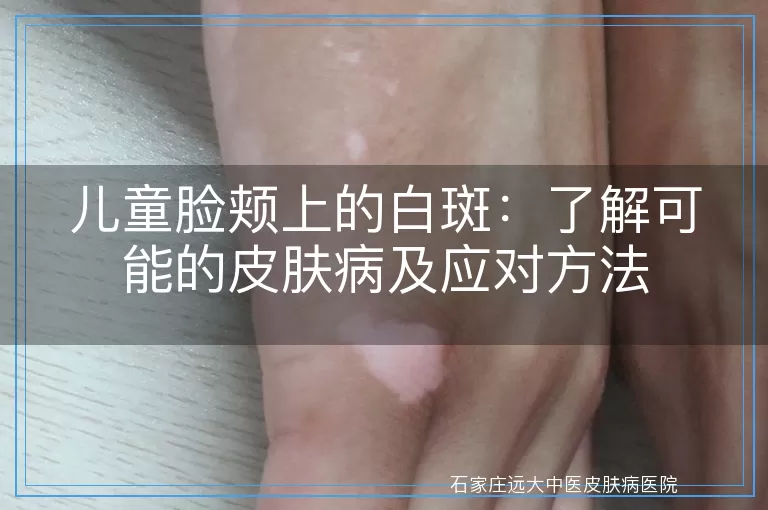 儿童脸颊上的白斑：了解可能的皮肤病及应对方法