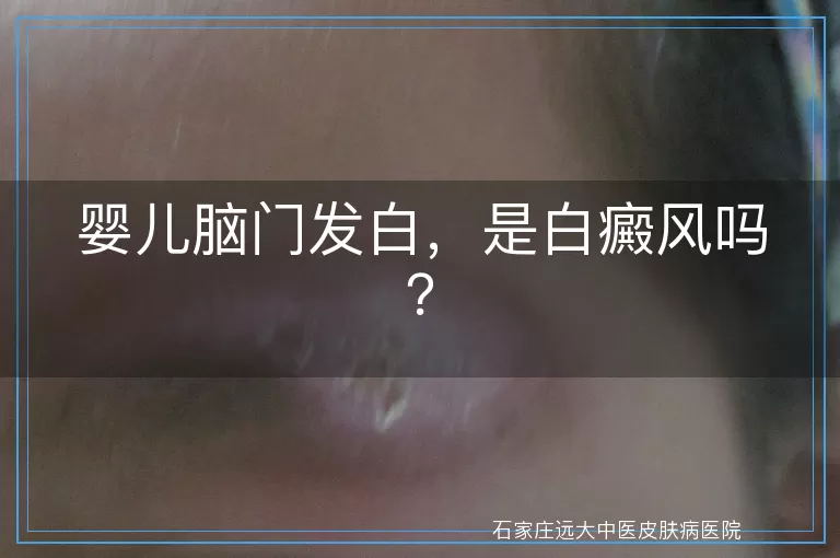 婴儿脑门发白，是白癜风吗？