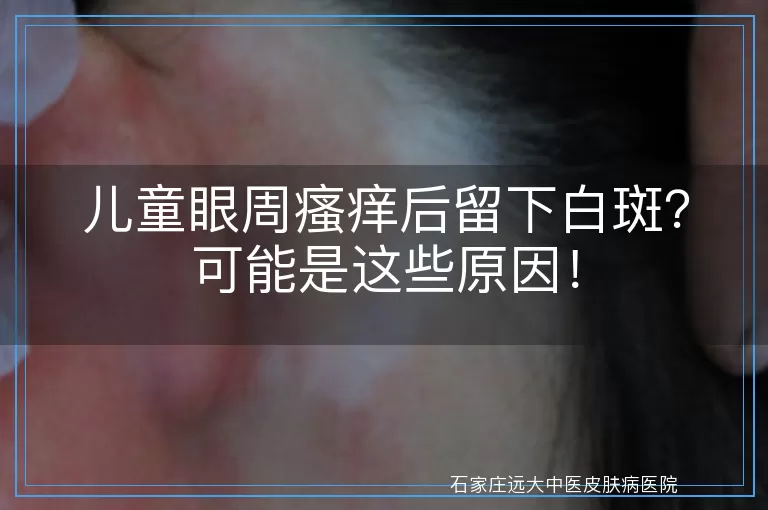儿童眼周瘙痒后留下白斑？可能是这些原因！