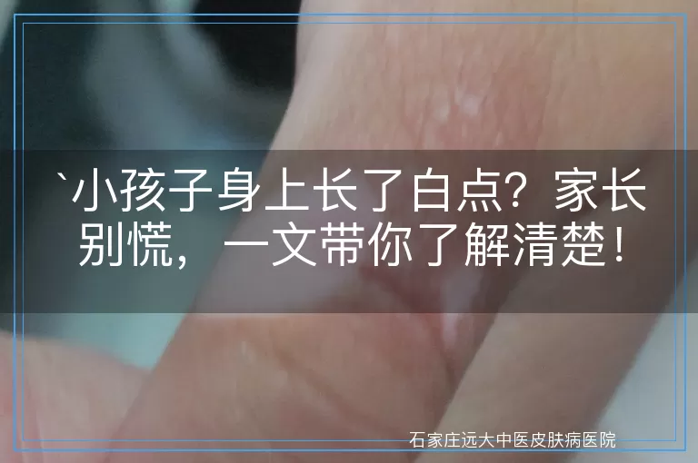 小孩子身上长了白点？家长别慌，一文带你了解清楚！