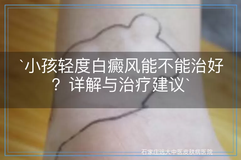 小孩轻度白癜风能不能治好？详解与治疗建议