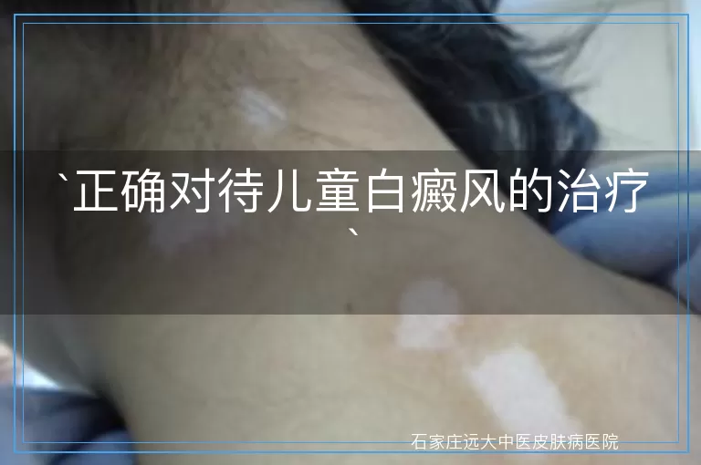 正确对待儿童白癜风的治疗