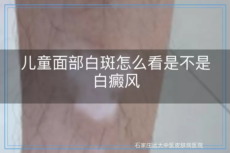 儿童面部白斑怎么看是不是白癜风