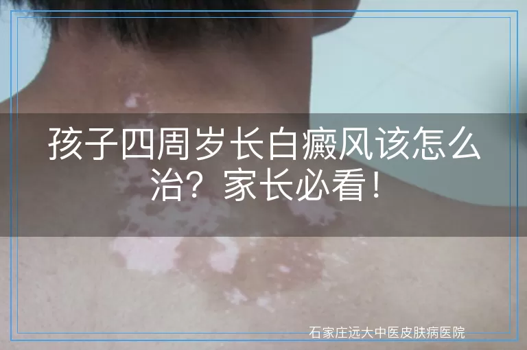 孩子四周岁长白癜风该怎么治？家长必看！