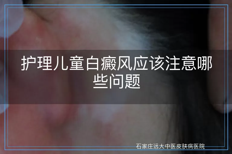 护理儿童白癜风应该注意哪些问题