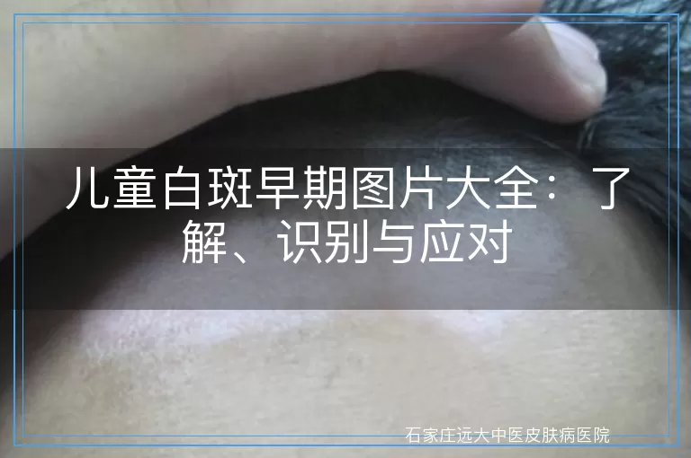 儿童白斑早期图片大全:了解、识别与应对
