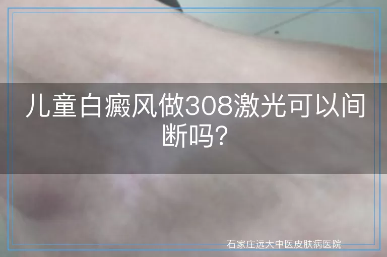 儿童白癜风做308激光可以间断吗？