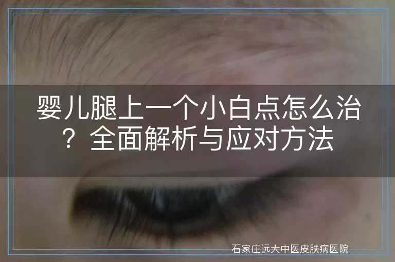 婴儿腿上一个小白点怎么治？全面解析与应对方法