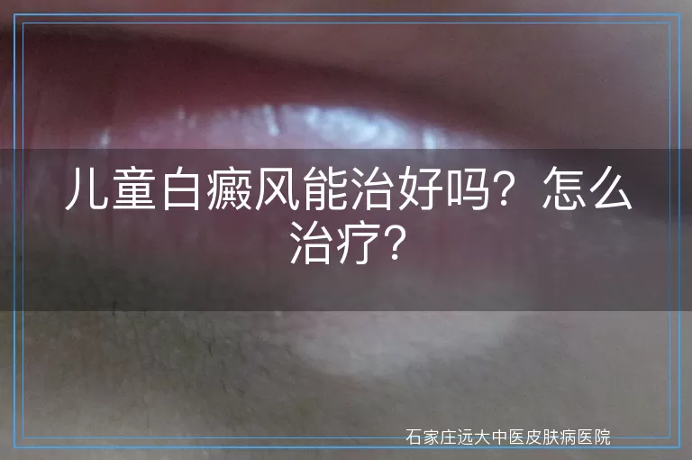 儿童白癜风能治好吗？怎么治疗？