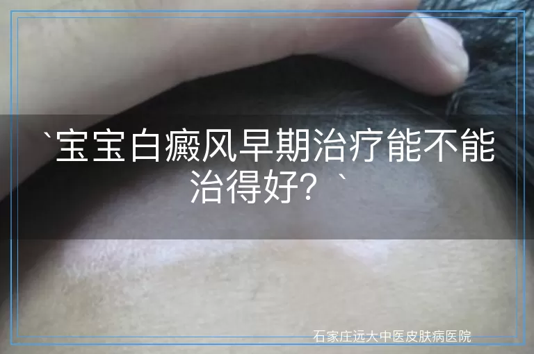 宝宝白癜风早期治疗能不能治得好？