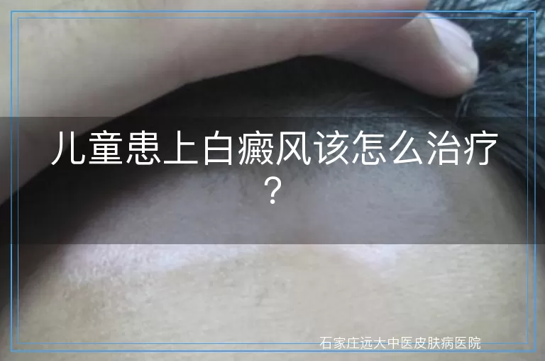 儿童患上白癜风该怎么治疗？