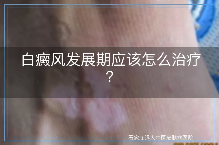 白癜风发展期应该怎么治疗?