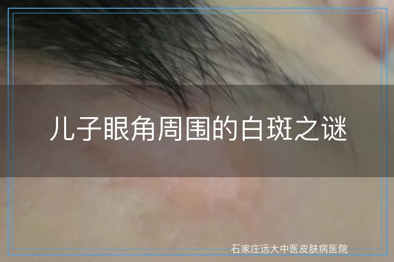 儿子眼角周围的白斑之谜