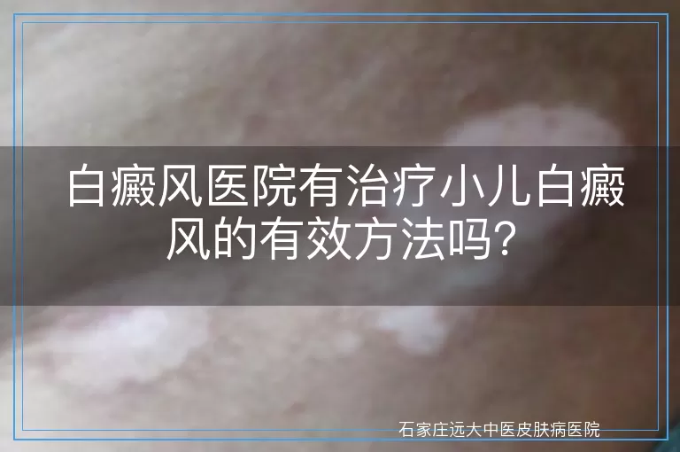 白癜风医院有治疗小儿白癜风的有效方法吗？